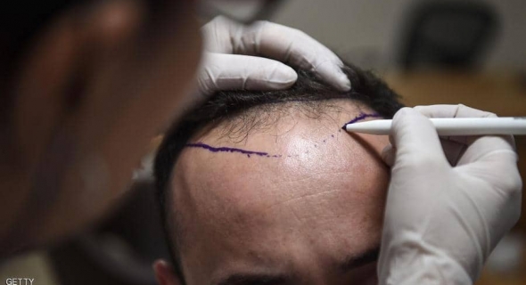 وفاة شخص في عملية زراعة شعر تحير الأطباء