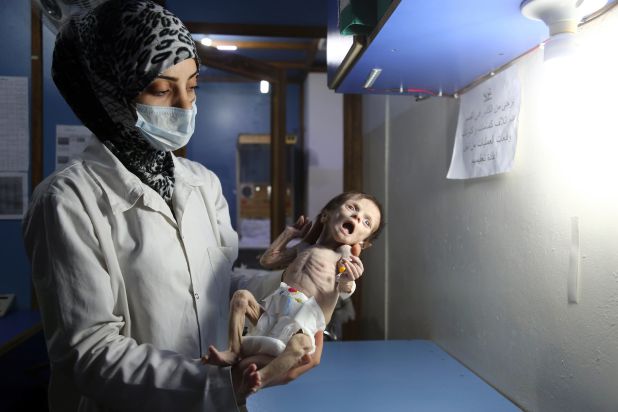 A Syrian infant suffering from severe malnutrition is carried by a nurse at a clinic in the rebel-controlled town of Kafr Batna, in the eastern Ghouta region on the outskirts of the capital Damascus, on October 21, 2017. / AFP PHOTO / Amer ALMOHIBANY