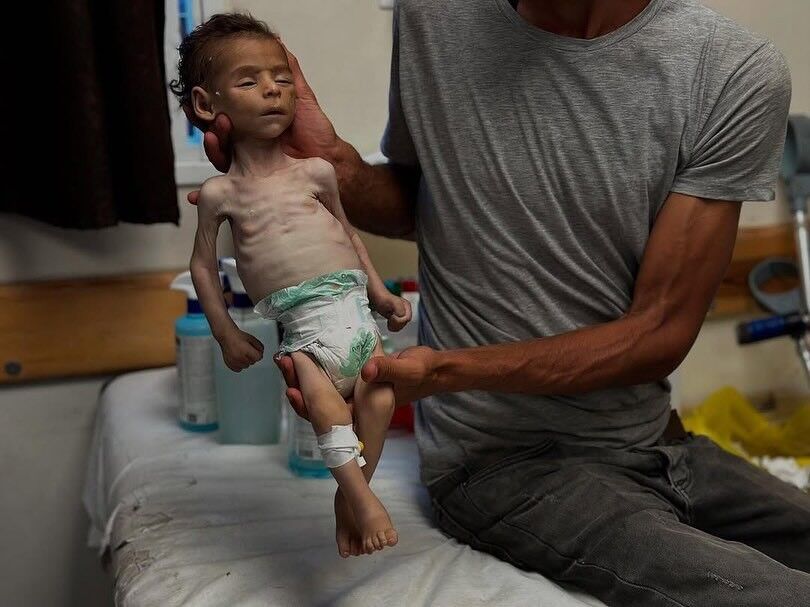 11 حالة وفاة جديدة نتيجة المجاعة بغزة خلال 24 ساعة